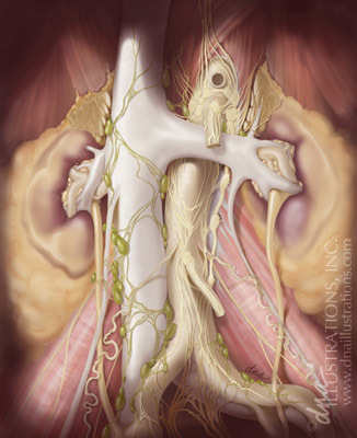 Laparoscopic RPLND